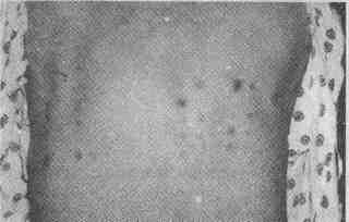http://med-enc.narod.ru/dermatolog/tmp61A1-2.jpg